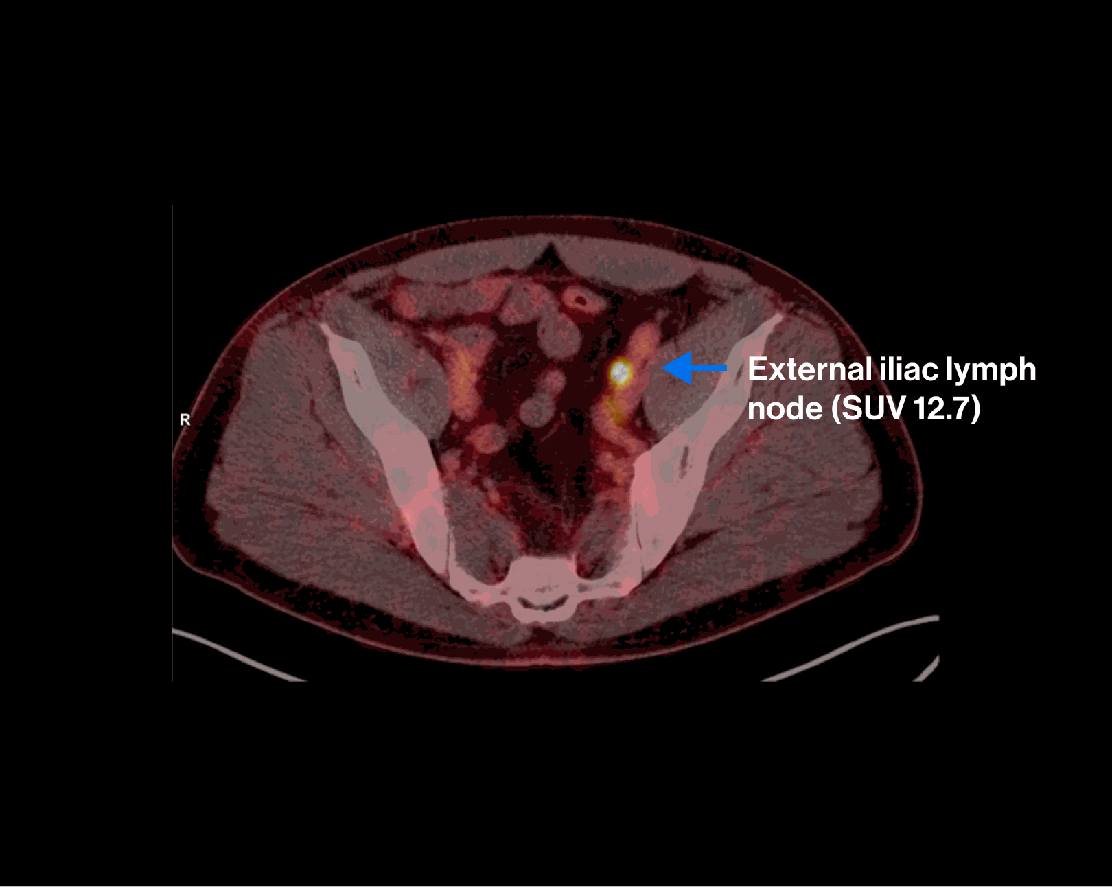 PET/CT scan — Scenario 1 Patient A