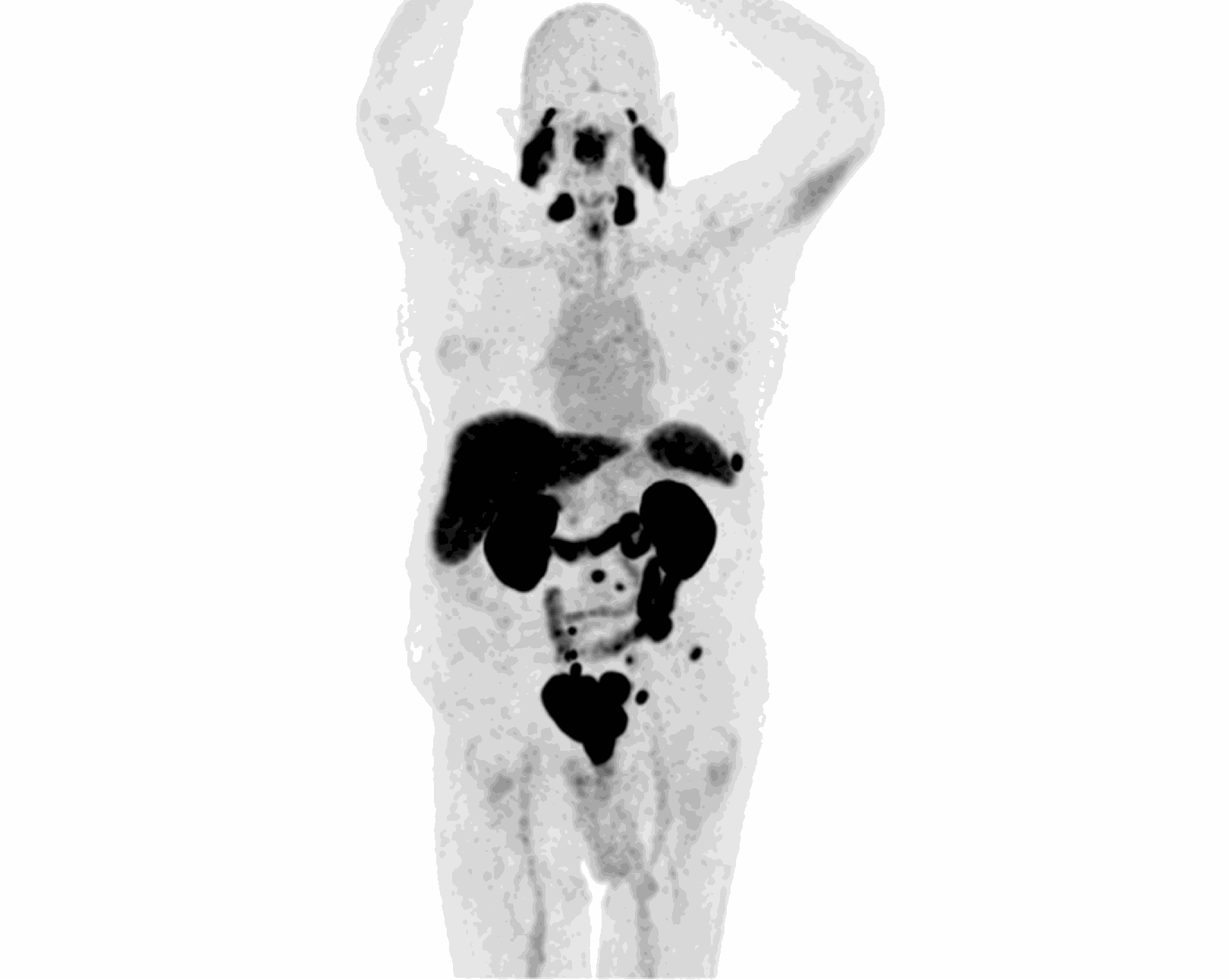 MIP scan — Scenario 1 Patient B