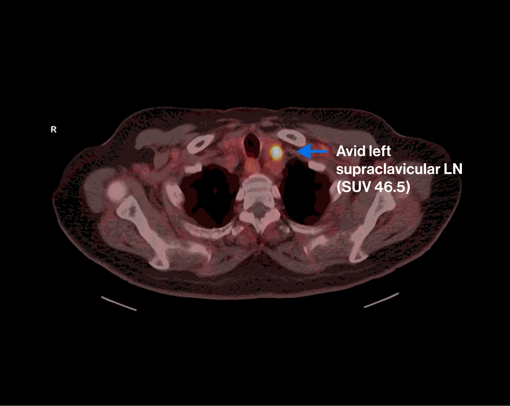 PET/CT scan — Scenario 1 Patient B