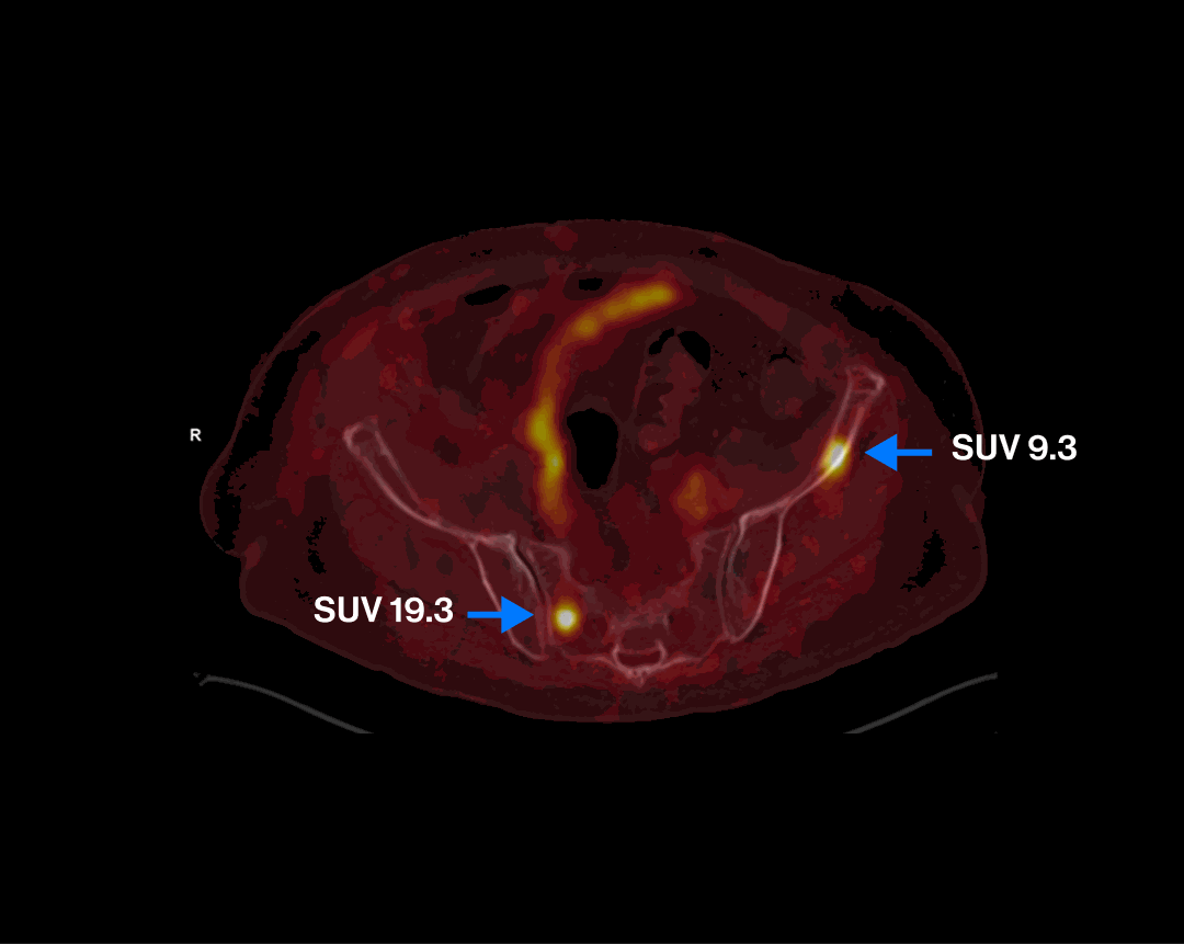 PET/CT scan — Scenario 1 Patient A, pelvic nodal and bone metastases highlighted