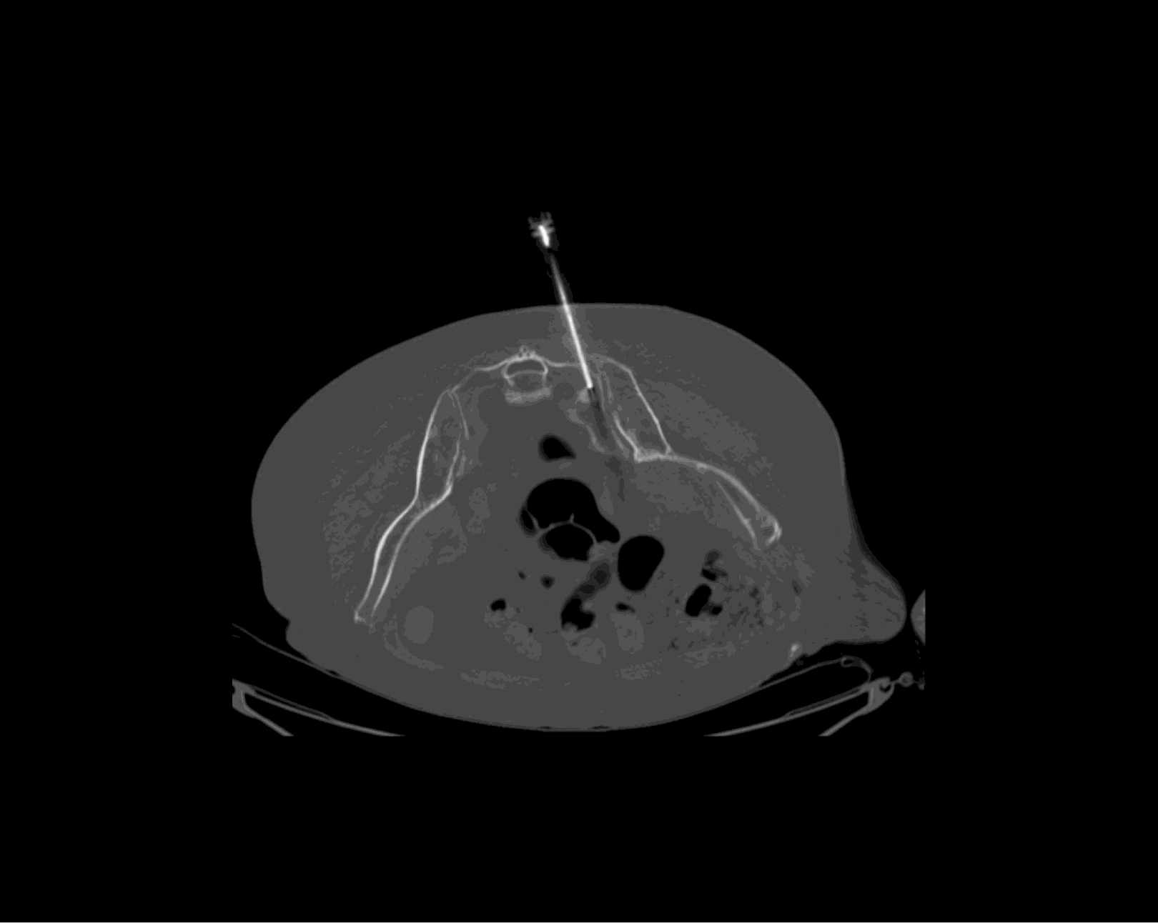 Biopsy confirmed bone metastases — Scenario 1 Patient A