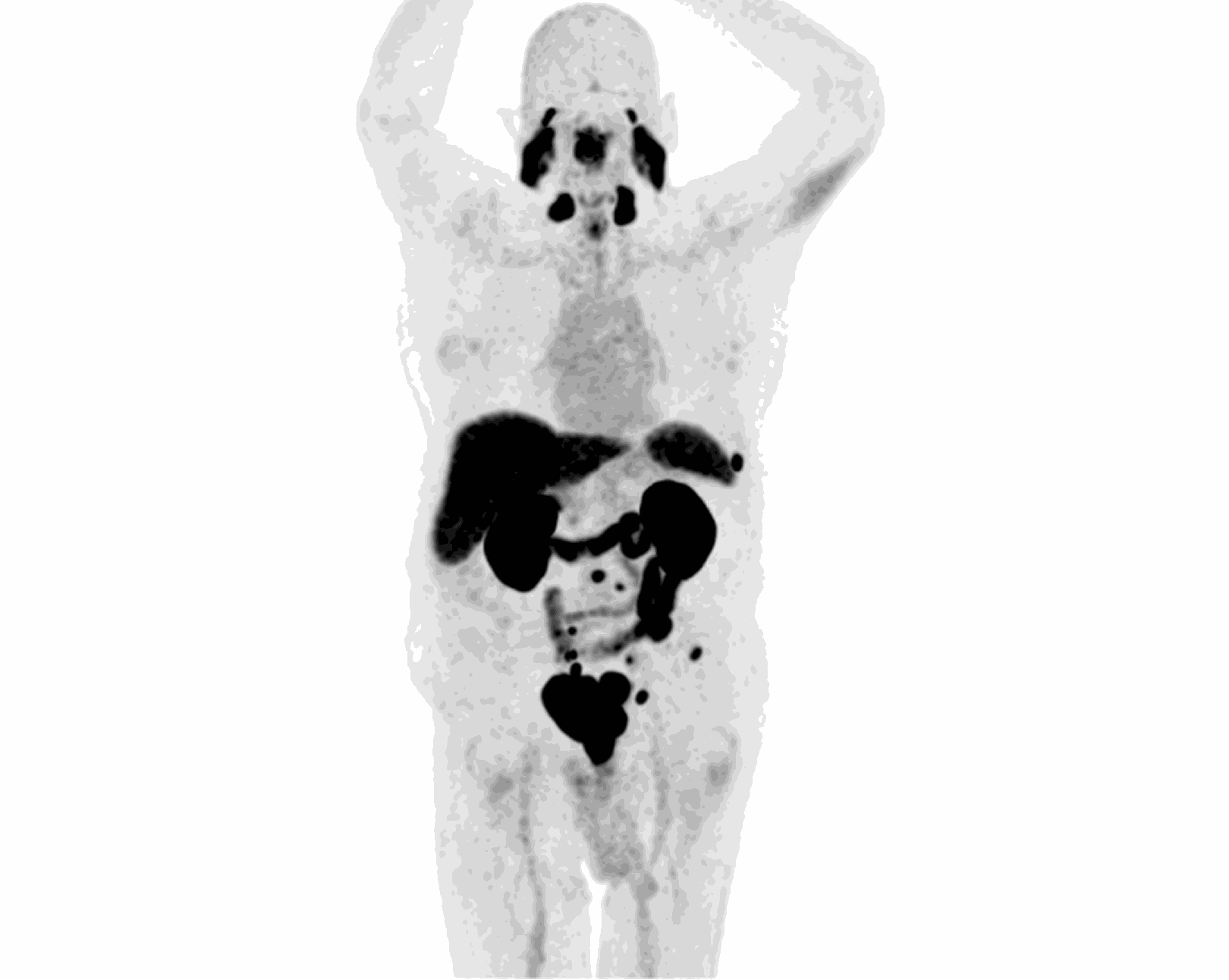 PET/CT MIP scan — Scenario 1 Patient A