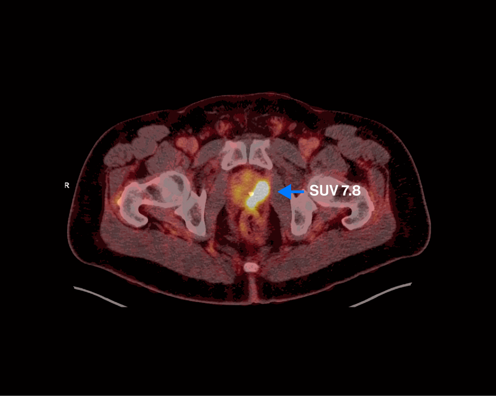 PET/CT scan — Scenario 1 Patient B, prostate primary highlighted