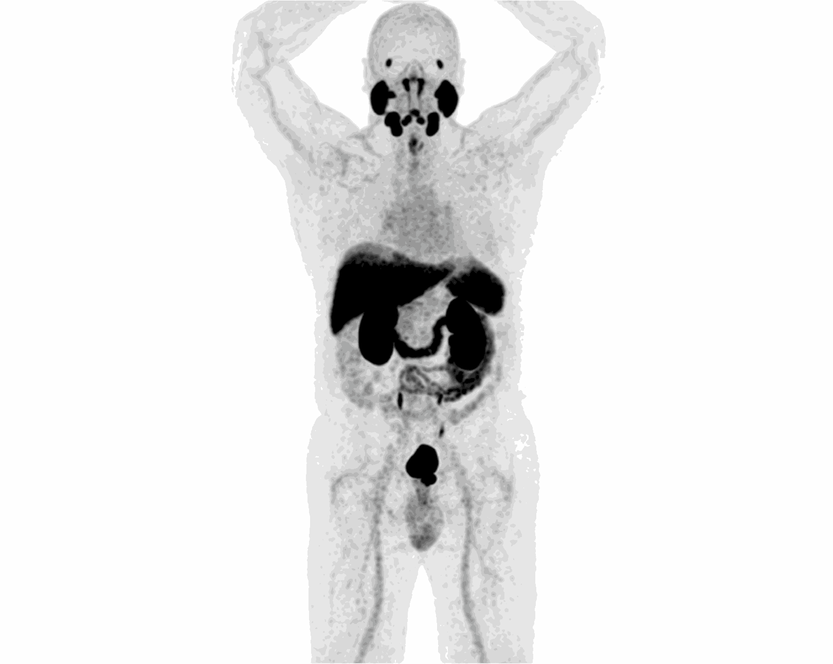 PET/CT MIP scan — Scenario 1 Patient B