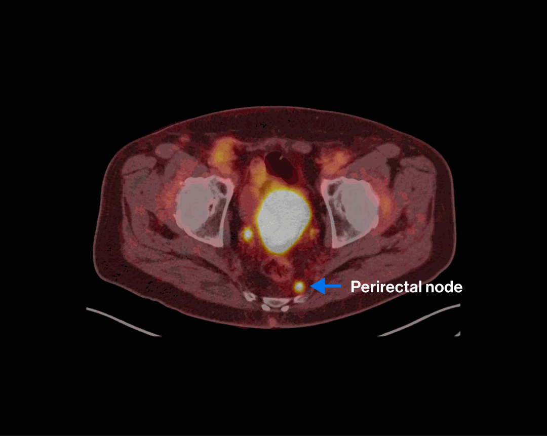 PET/CT scan — Scenario 2 Patient A, perirectal nodal metastasis highlighted