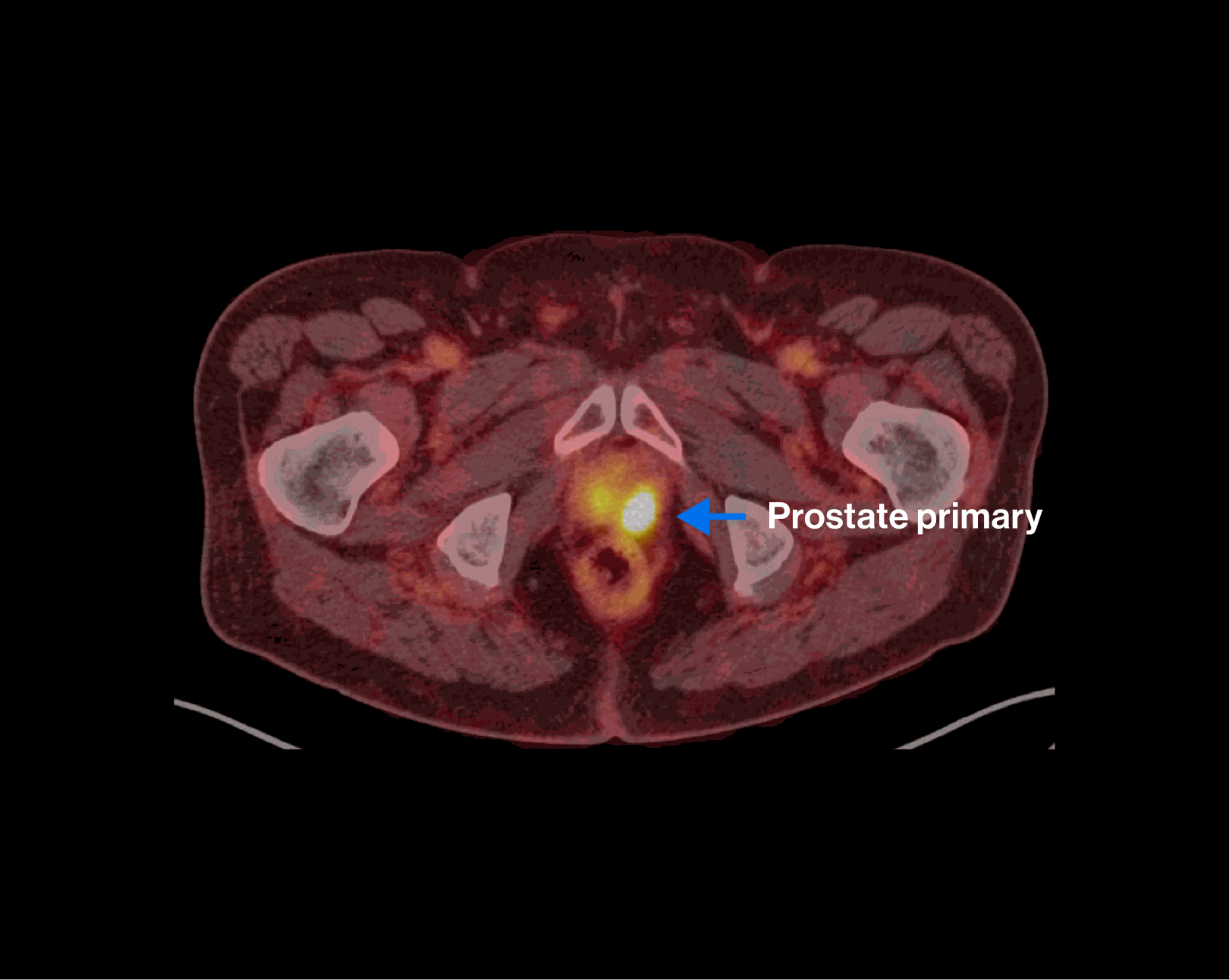 PET/CT scan — Scenario 2 Patient A, prostate primary highlighted