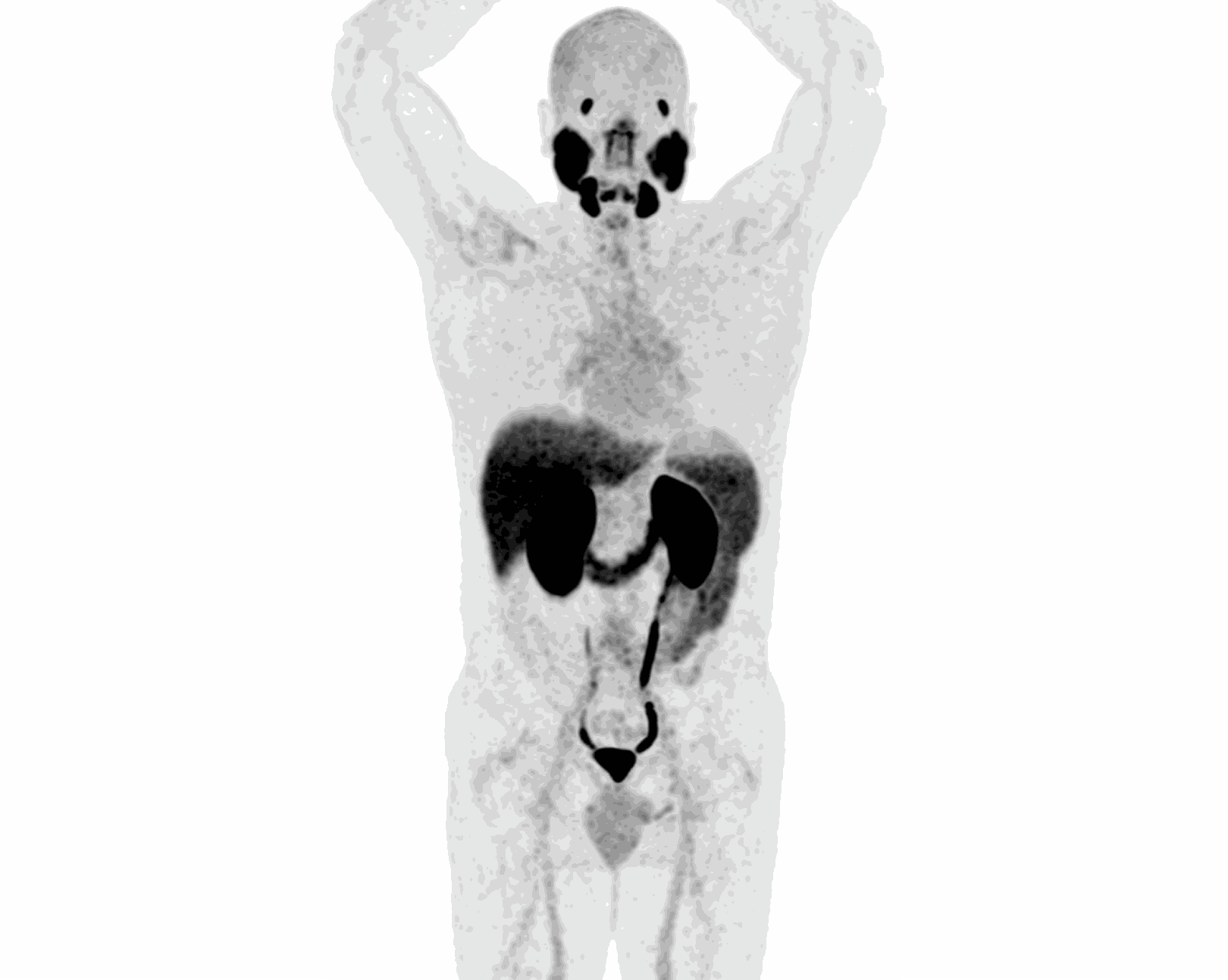 PET/CT MIP scan — Scenario 2 Patient A