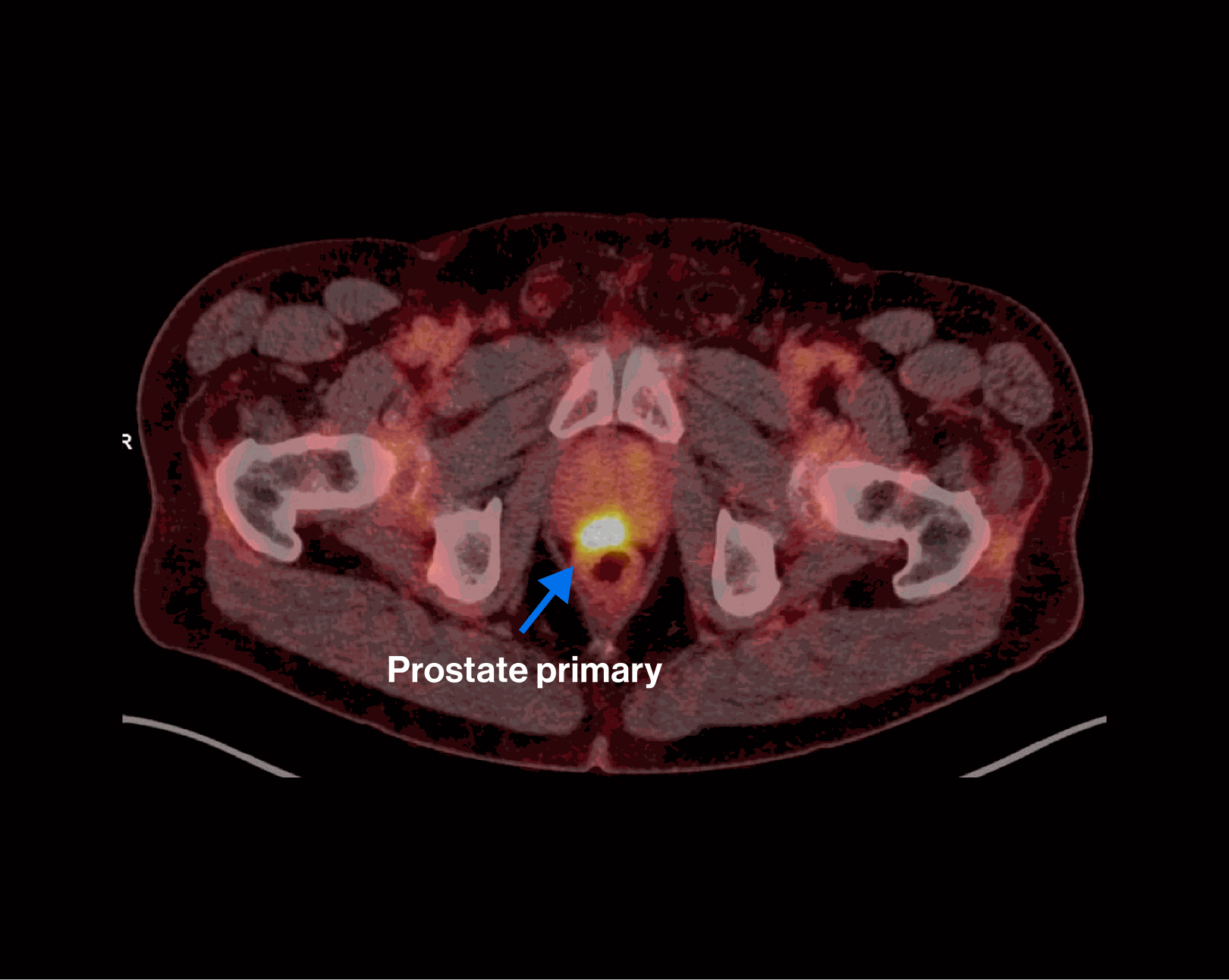 PET/CT scan — Scenario 2 Patient B, prostate primary highlighted