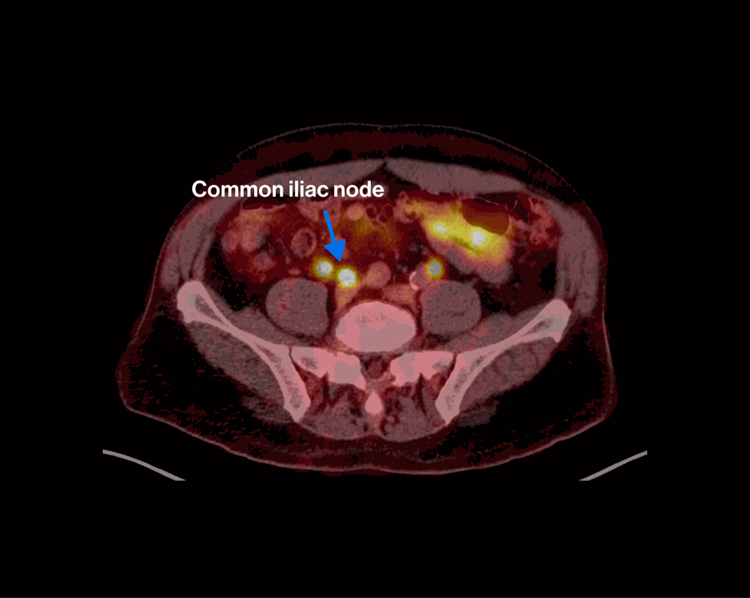 PET/CT scan — Scenario 2 Patient B, common iliac nodal metastasis highlighted
