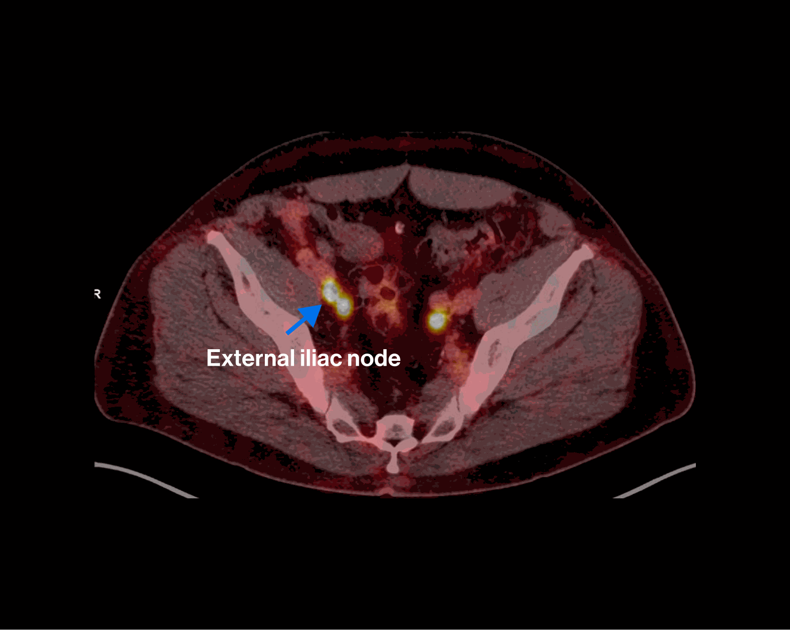 PET/CT scan — Scenario 2 Patient B, external iliac nodal metastasis highlighted