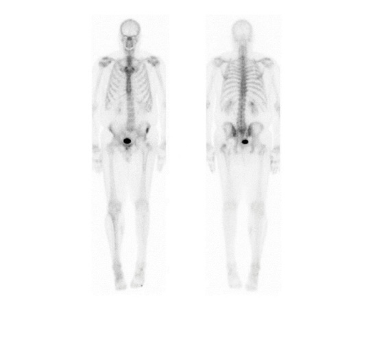 Bone scan: anterior and posterior views