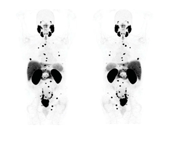 PSMA PET with prior formulation: anterior and posterior views